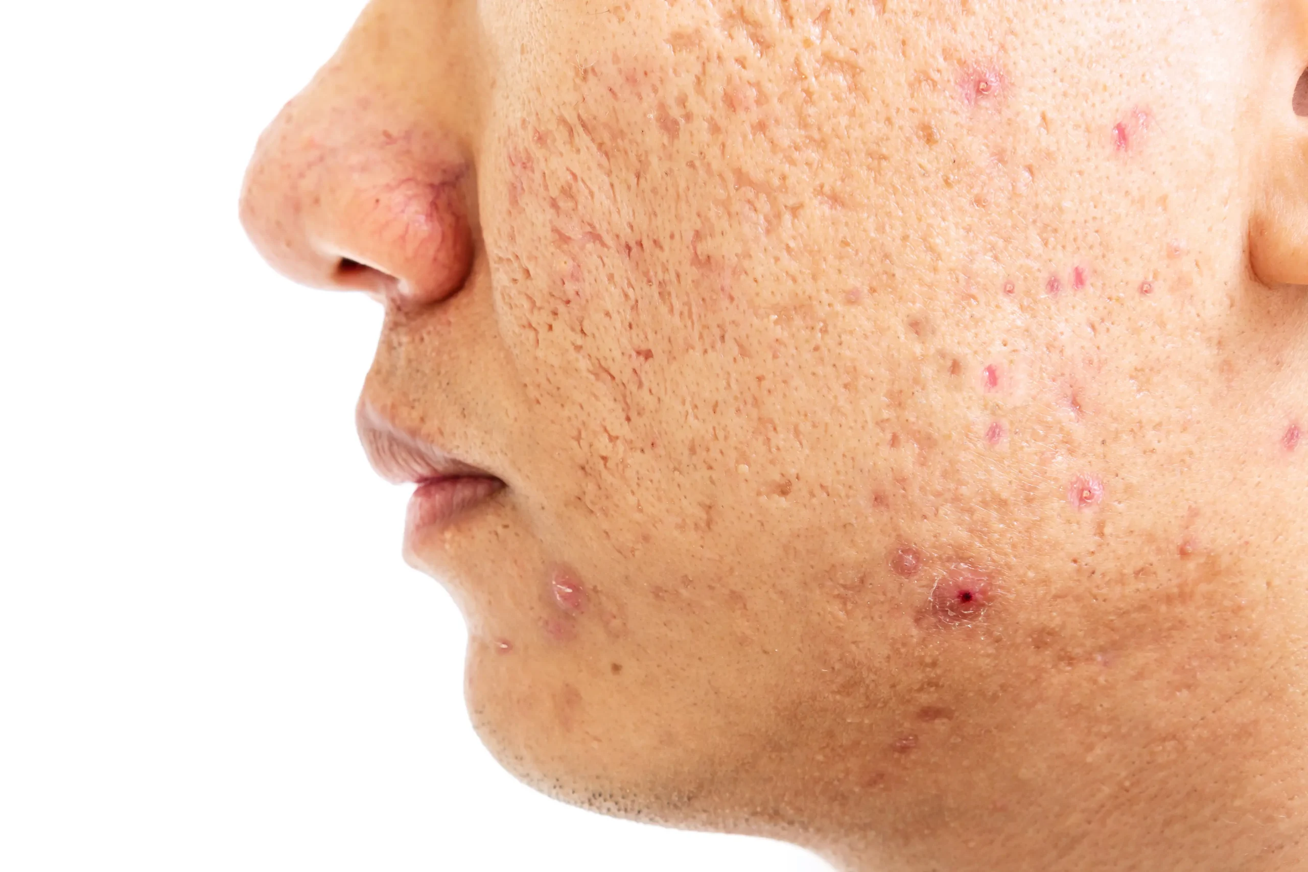 Acne Scarring