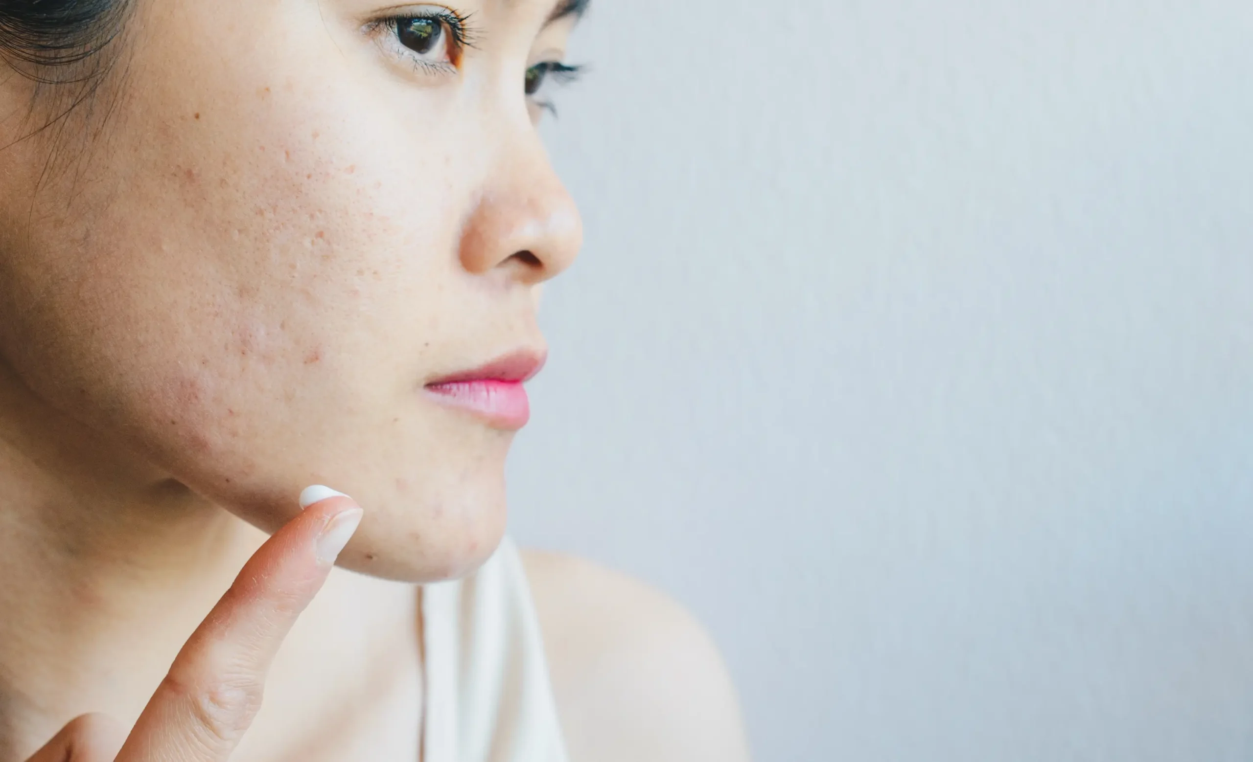 Tretinoin For Acne Scars