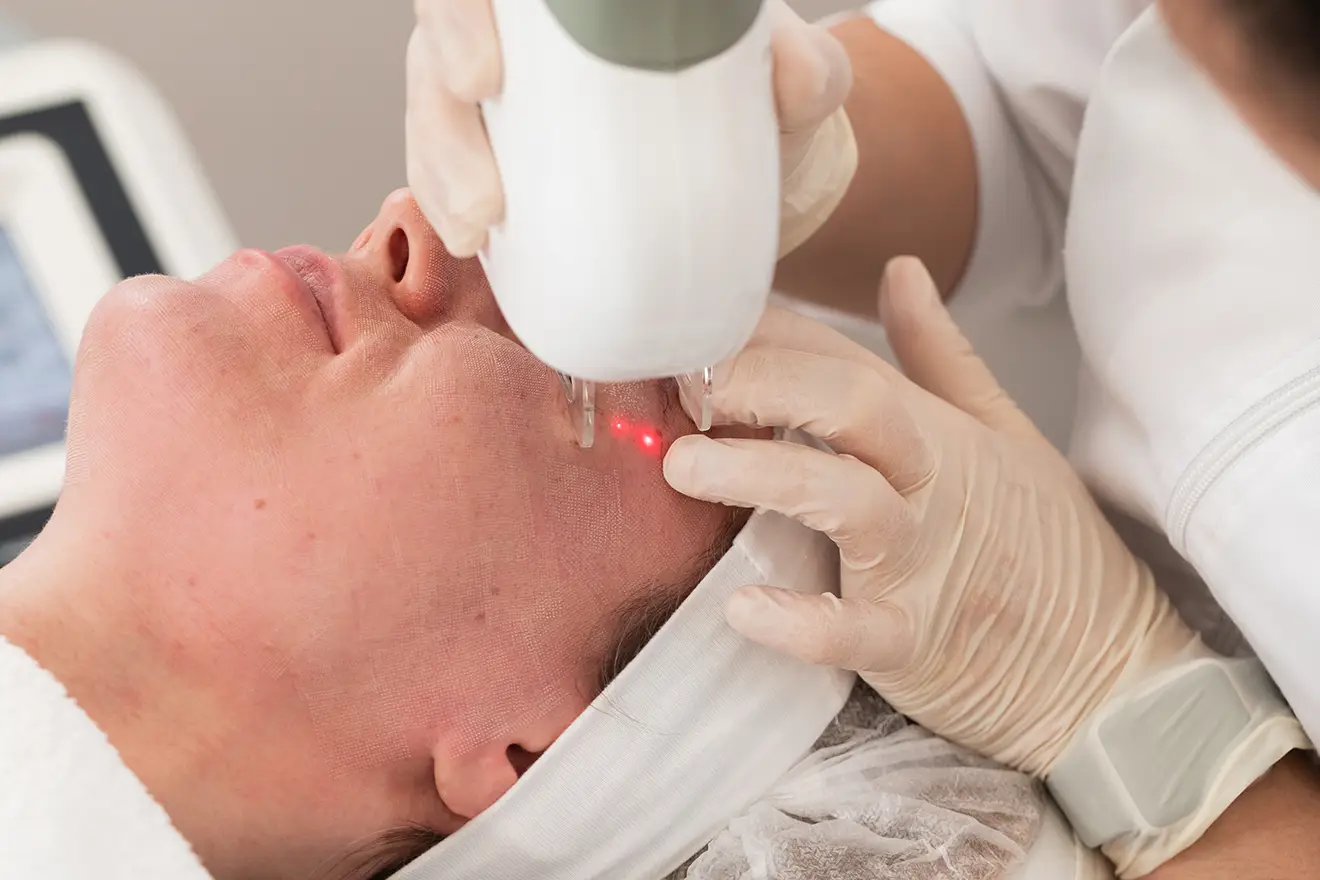 Types Of Lasers For Acne Scars