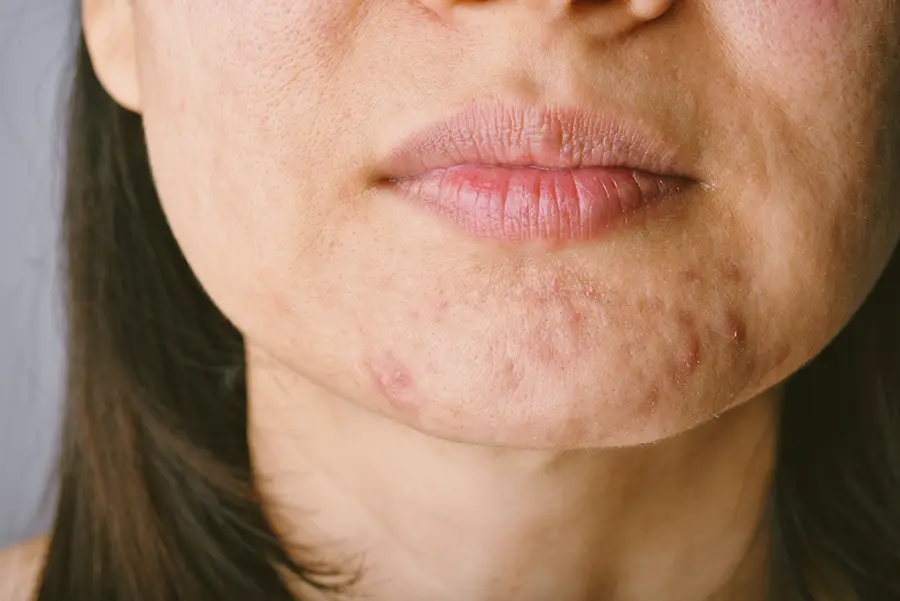 Types Of Acne Scars