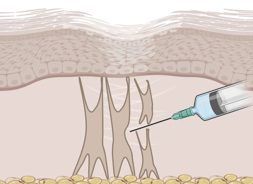 Subcision for Acne Scars