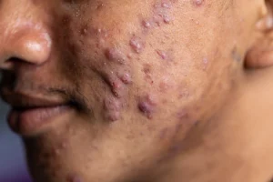 Cystic Acne Treatment Guide