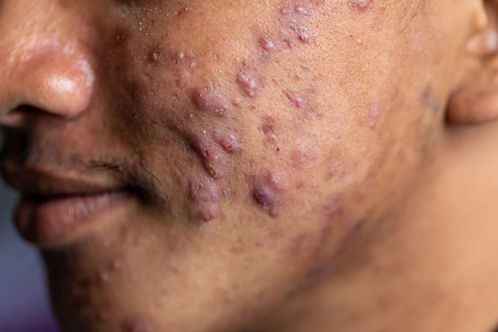 Cystic Acne Treatment Guide