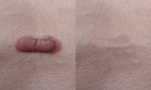 Keloid Acne Scars