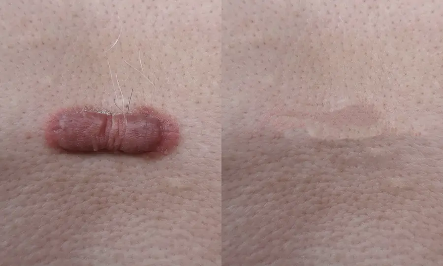 Keloid Acne Scars