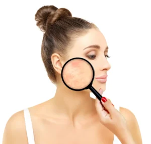 Post-Inflammatory Erythema (PIE) Treatments