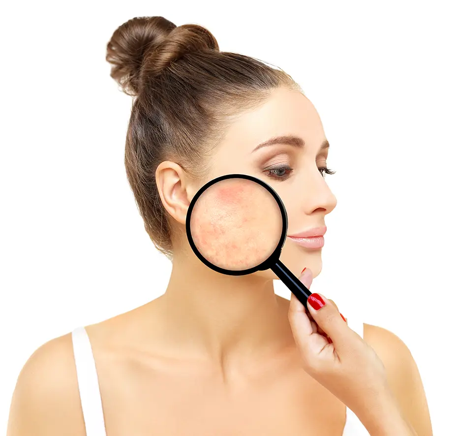 Post-Inflammatory Erythema (PIE) Treatments
