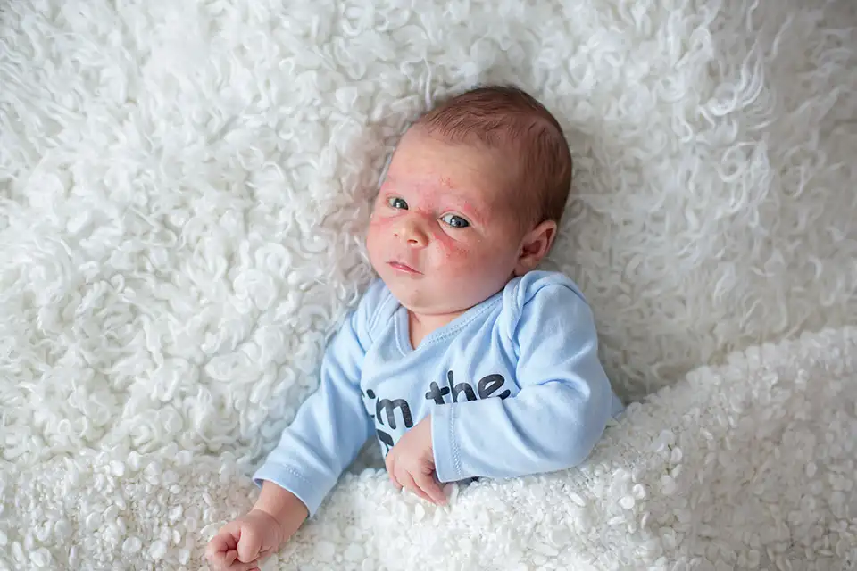 Baby Acne