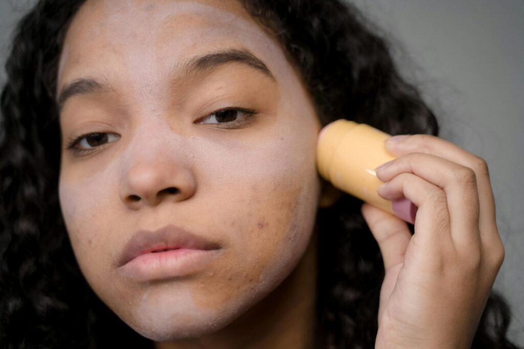 Can Thyroid Problems Cause Acne in Adults - Featured image