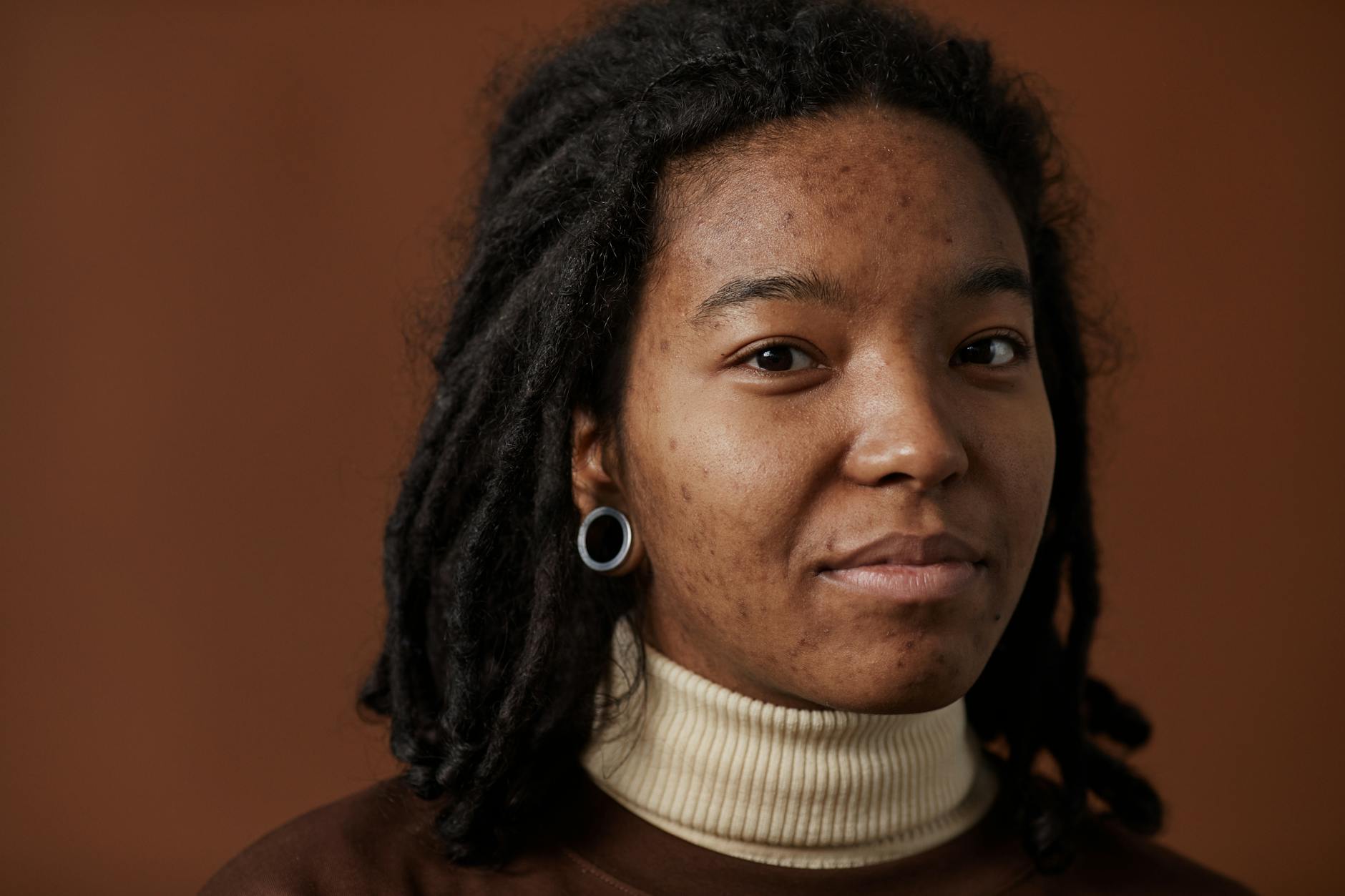 Acne and Anxiety Connection Gains Attention in New Study - Featured image