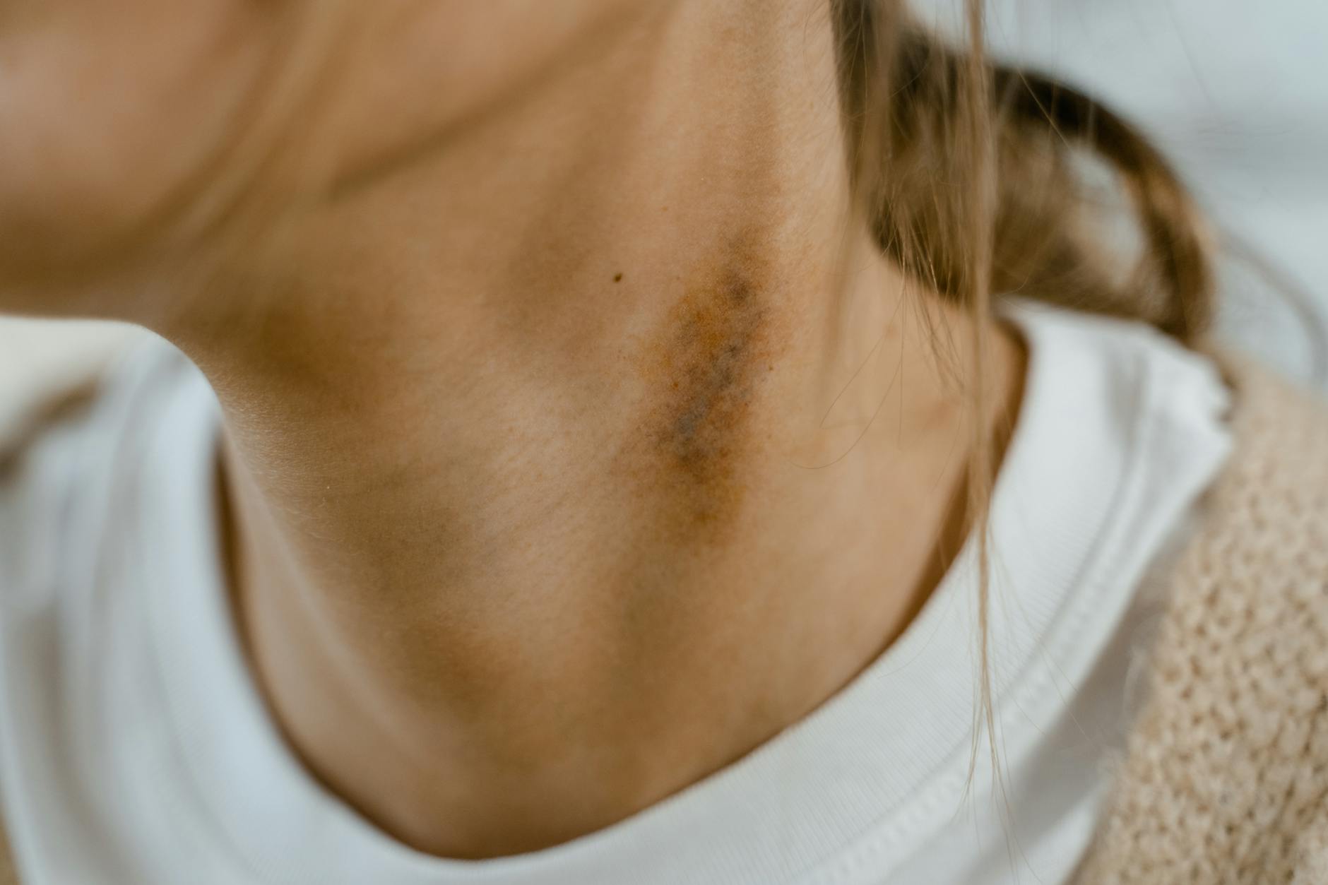 Bruising, Downtime, and Why Older Devices Are Now Considered Impractical