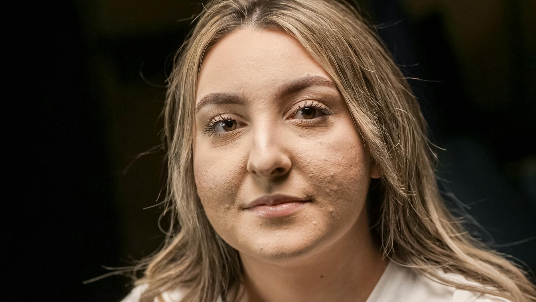 Celebrity Acne Journey Inspires New Beauty Business - Featured image