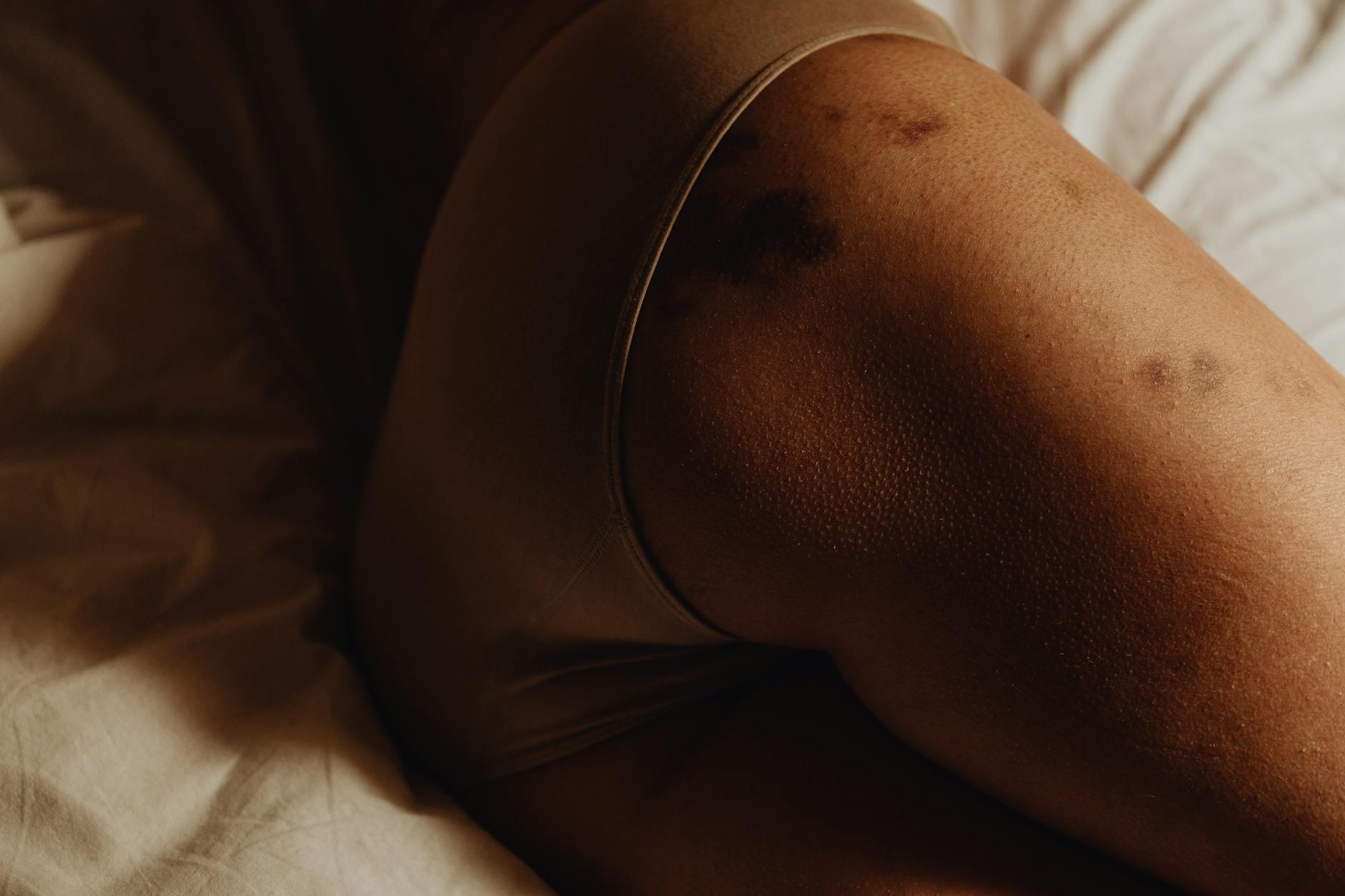 How Does Hero BBL Compare to Standard IPL for Treating Hyperpigmentation?