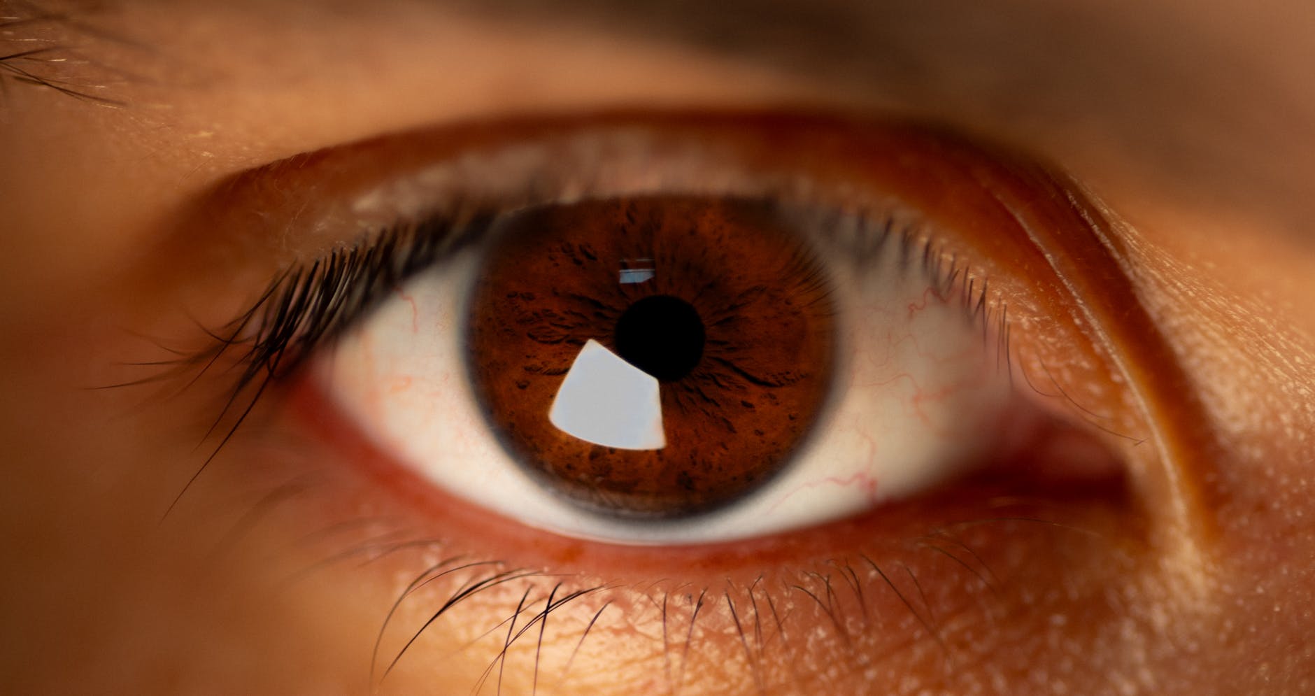 How Does Reflectance Confocal Microscopy Visualize Acne Pathology?