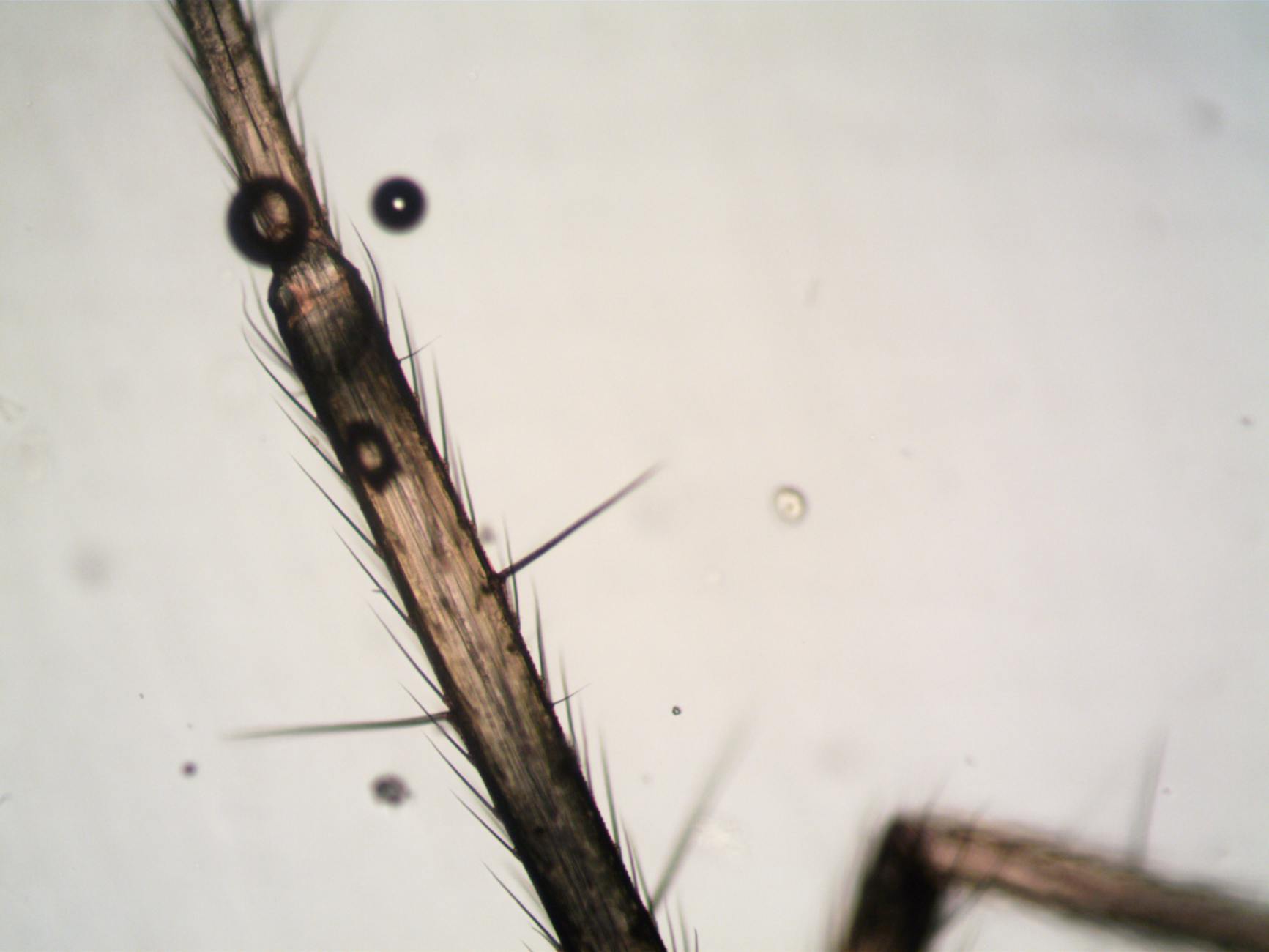 How Does the AAD Classify Acne Severity and What's the First Treatment Step?