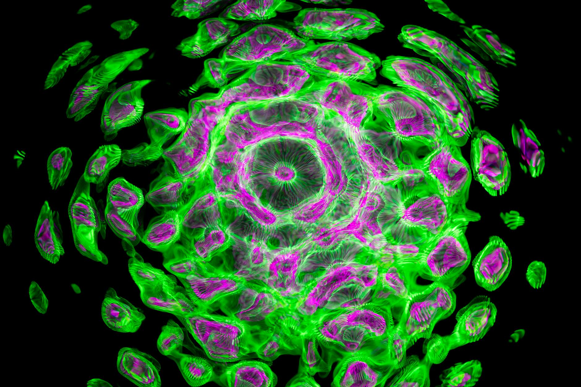 How Effective Is Bimekizumab in Clinical Trials for Plaque Psoriasis?