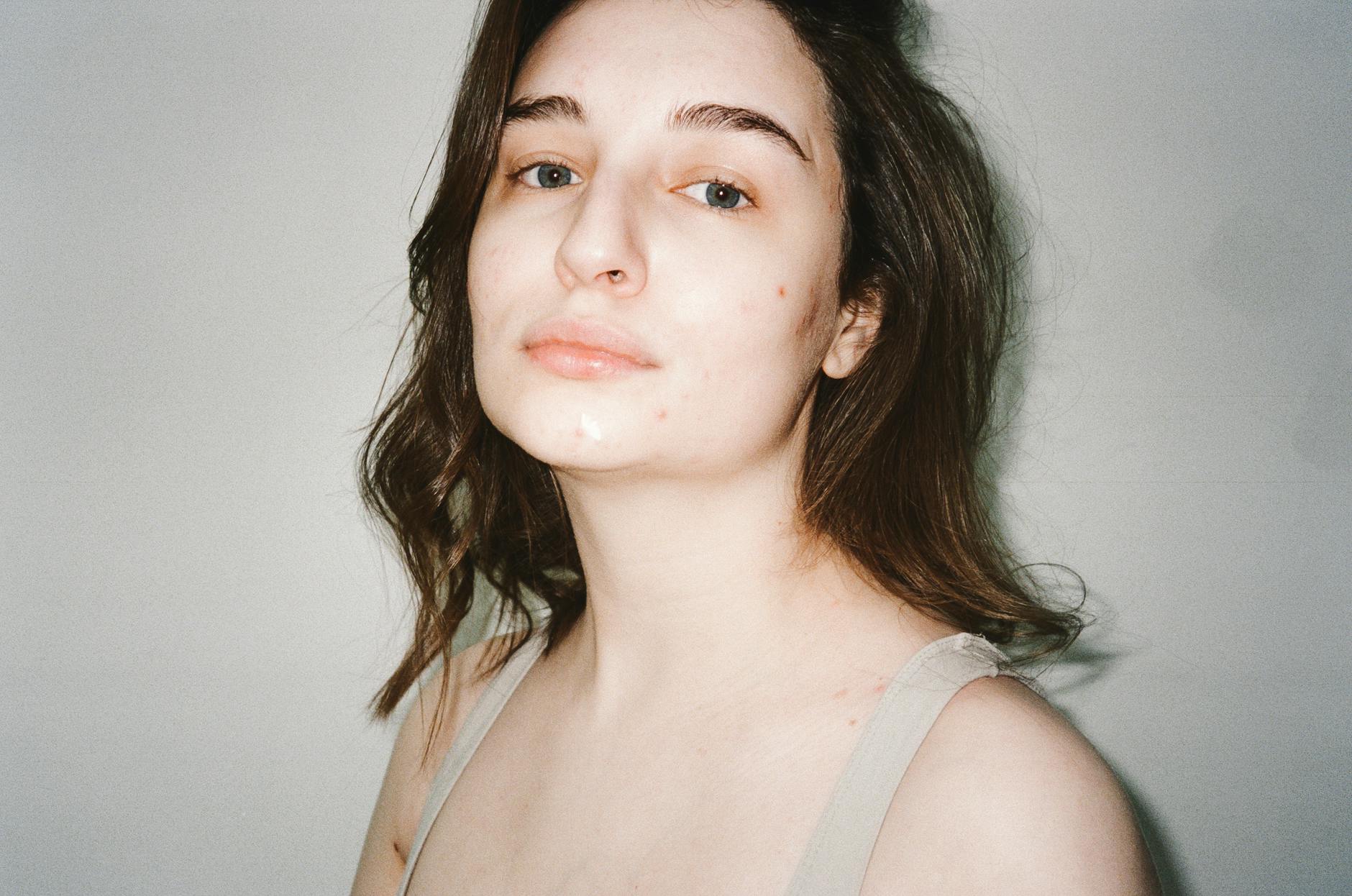 How Is the Acne Positivity Movement Challenging Traditional Beauty Ideals?
