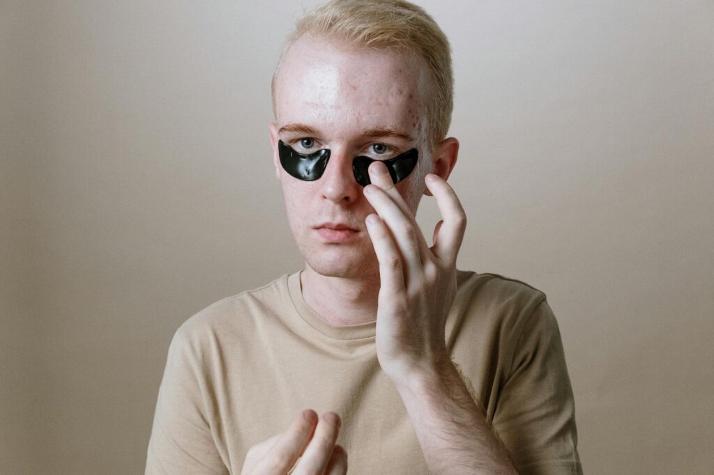 How to Maintain Results After Acne Improves - Featured image