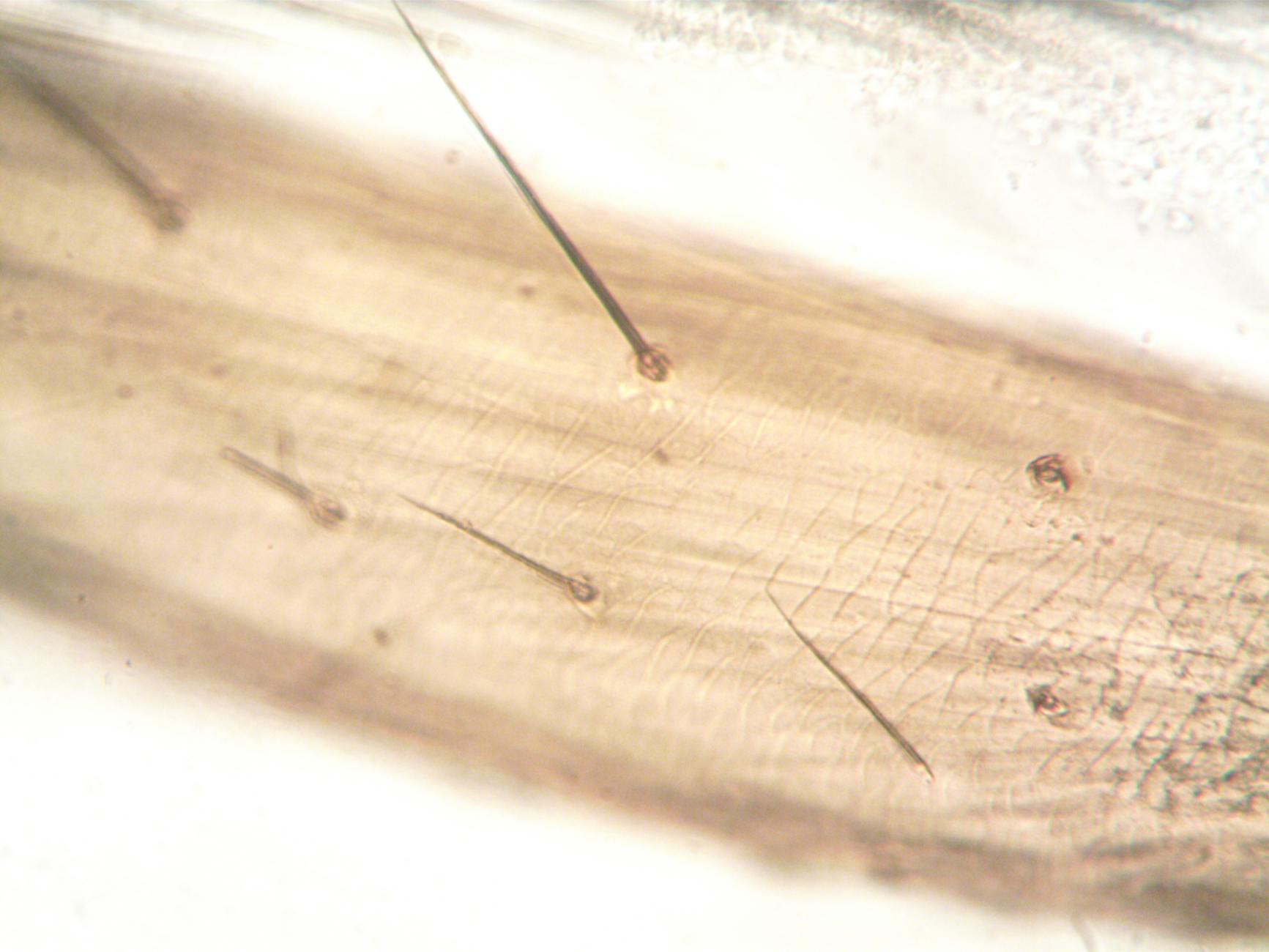 Identifying Closed Comedones Under Magnification