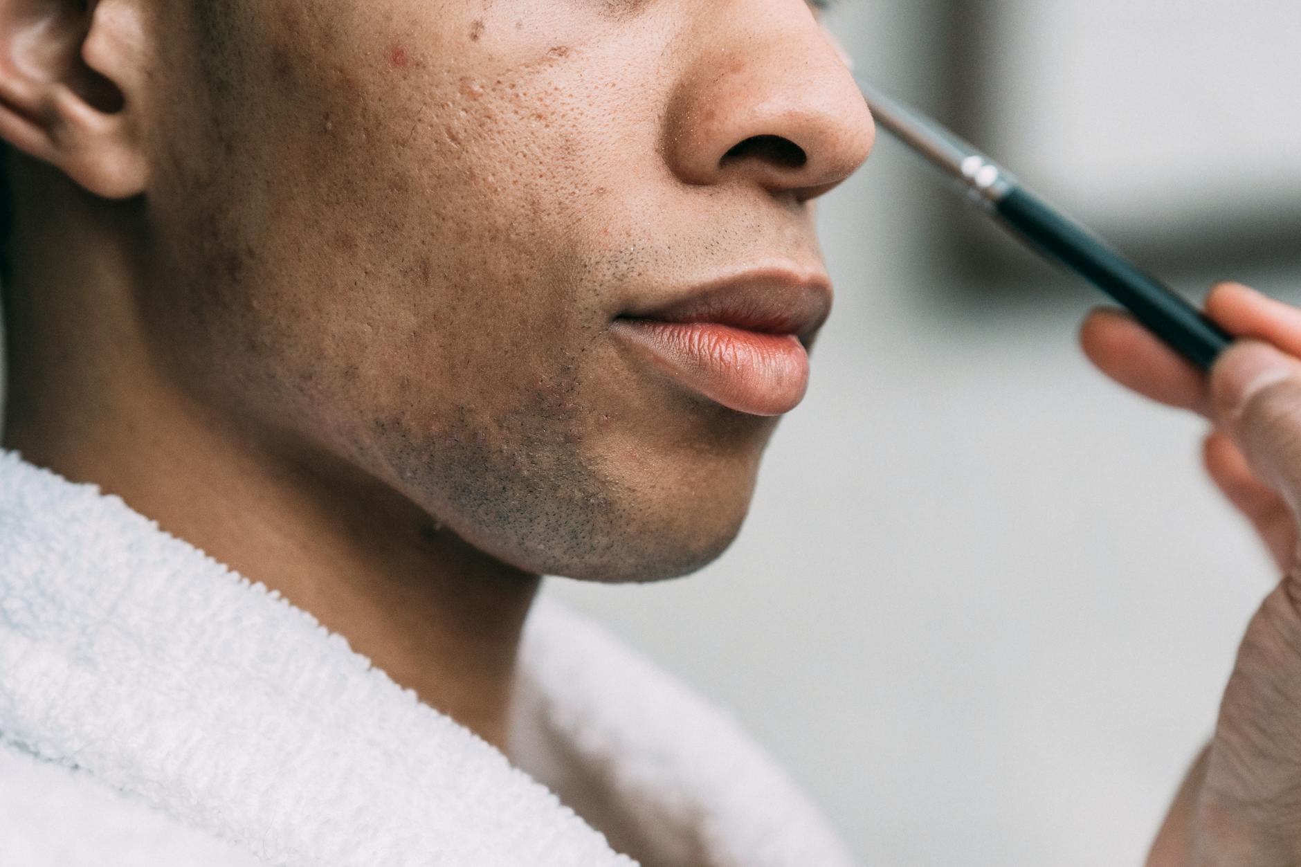 The Connection Between Overexfoliation and Increased Breakouts