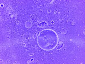 What Adipose-Derived Stem Cells Do for Depressed Acne Scars - Featured image