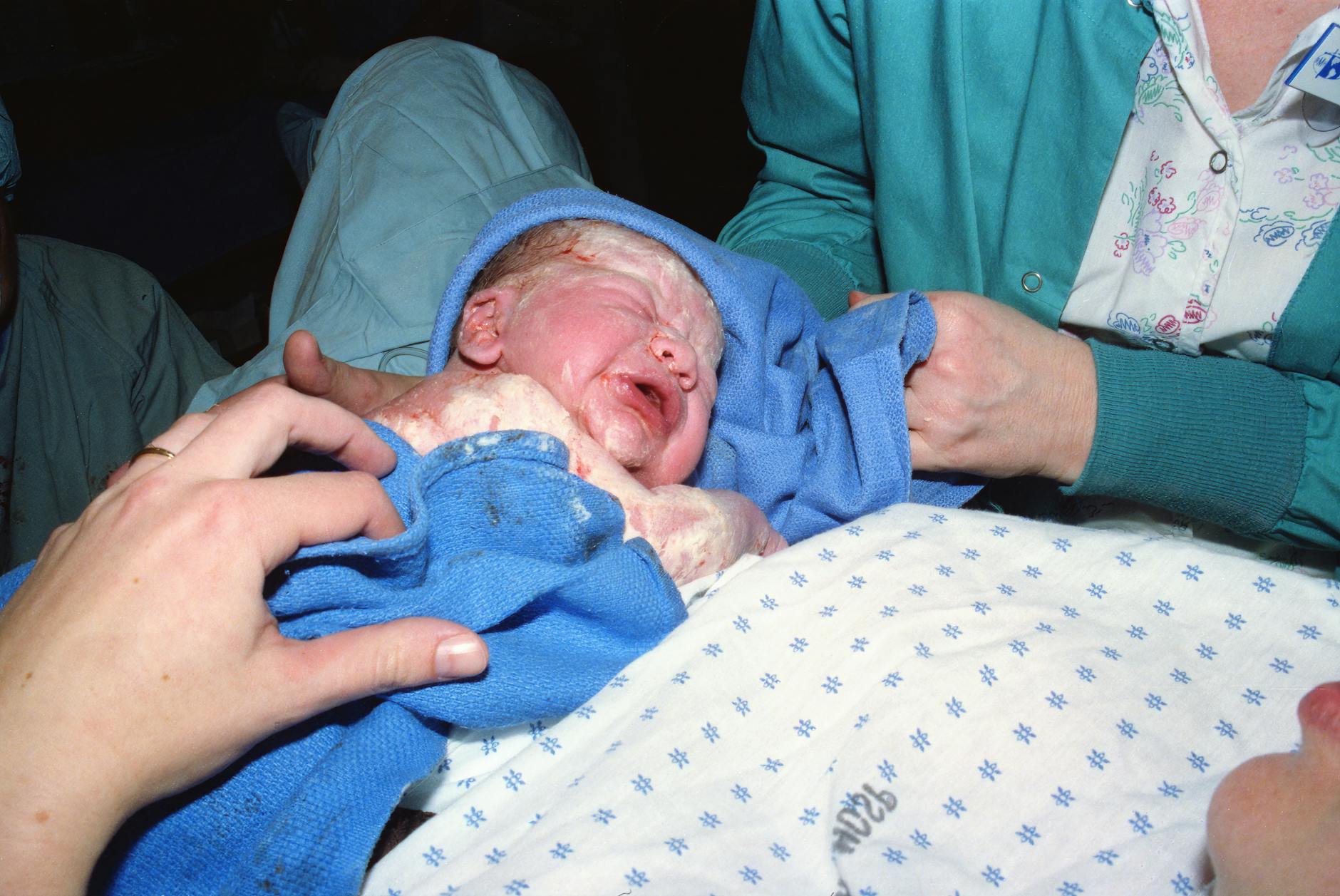 What Causes Acne After Switching Birth Control Pills - Featured image