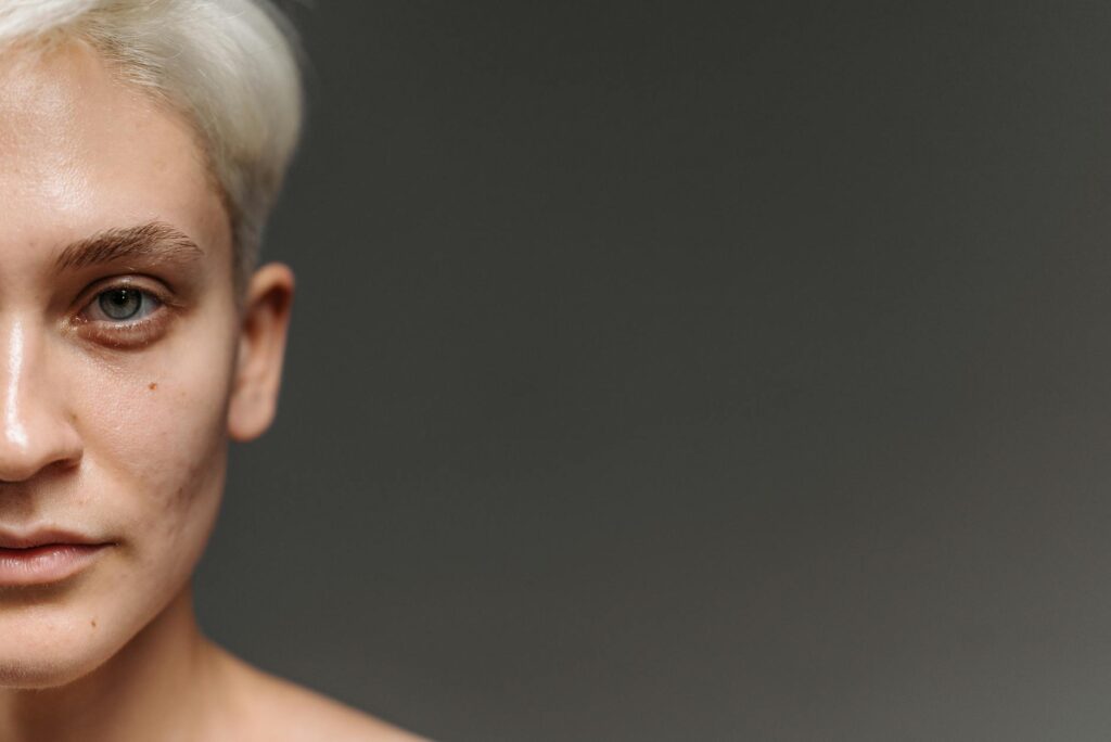 What CB-5945 Sebaceous Gland Inhibitor Is in Development For - Featured image