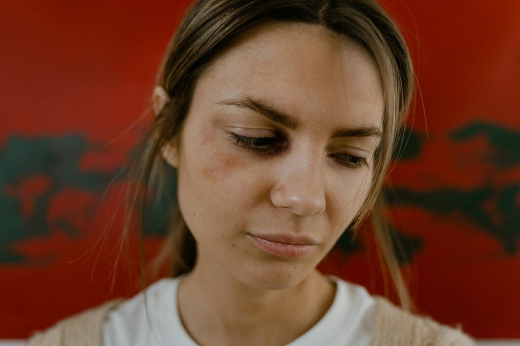 What Delayed Bruising After Subcision Indicates - Featured image