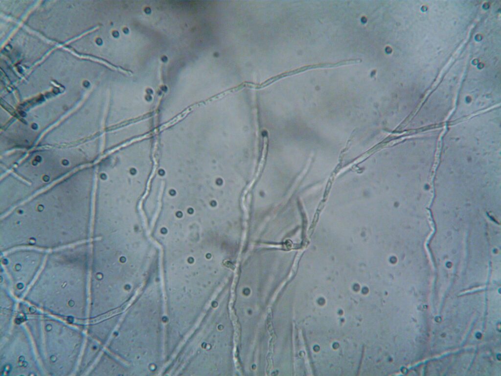 What Foods to Avoid If You Have Fungal Acne - Featured image