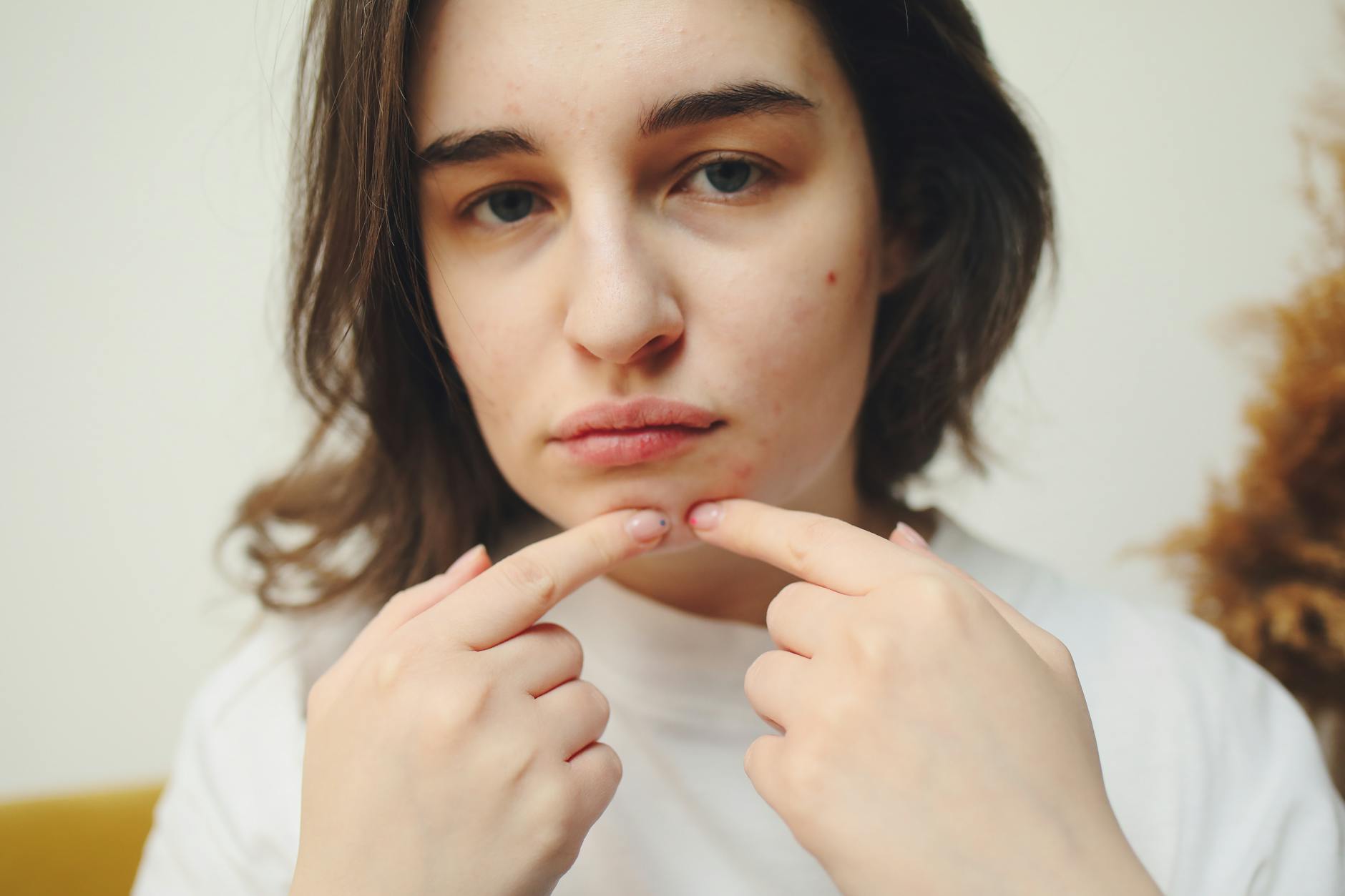 What Gene Therapy for Acne Scar Prevention Could Look Like - Featured image