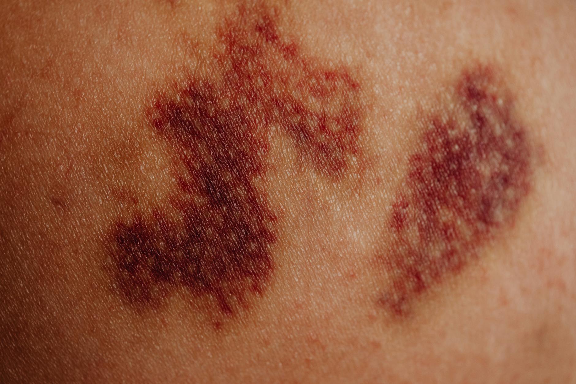 What Happens to Blood Vessels When Acne Causes Redness - Featured image