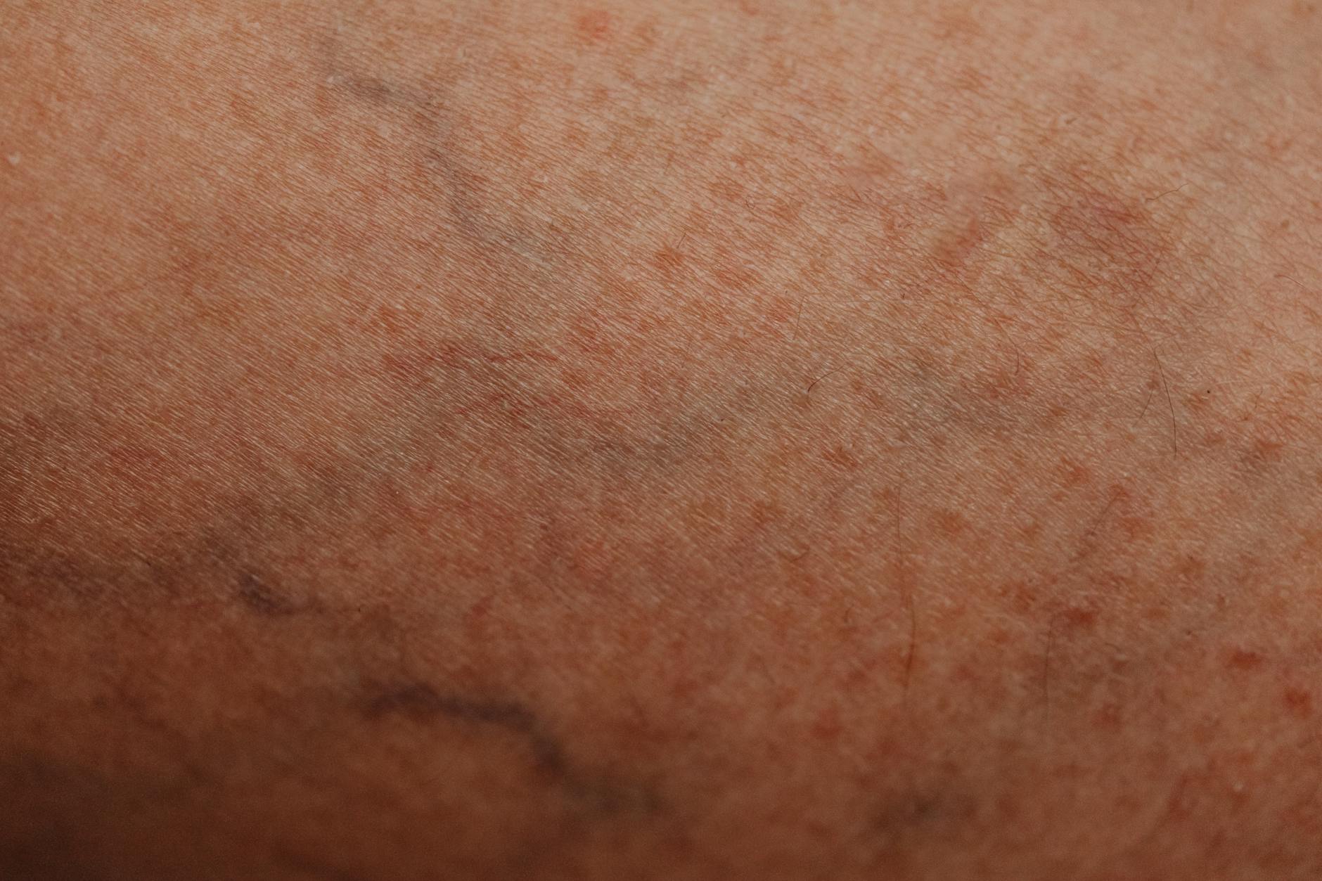 What Happens to PMMA Microspheres as Your Skin Ages?