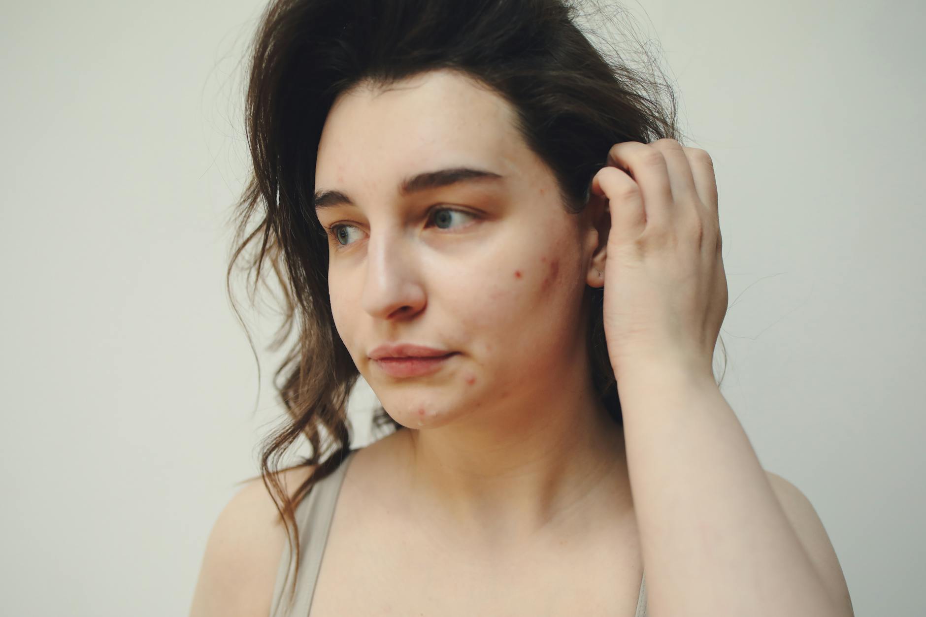 What Integrative Dermatology Offers for Acne Treatment - Featured image