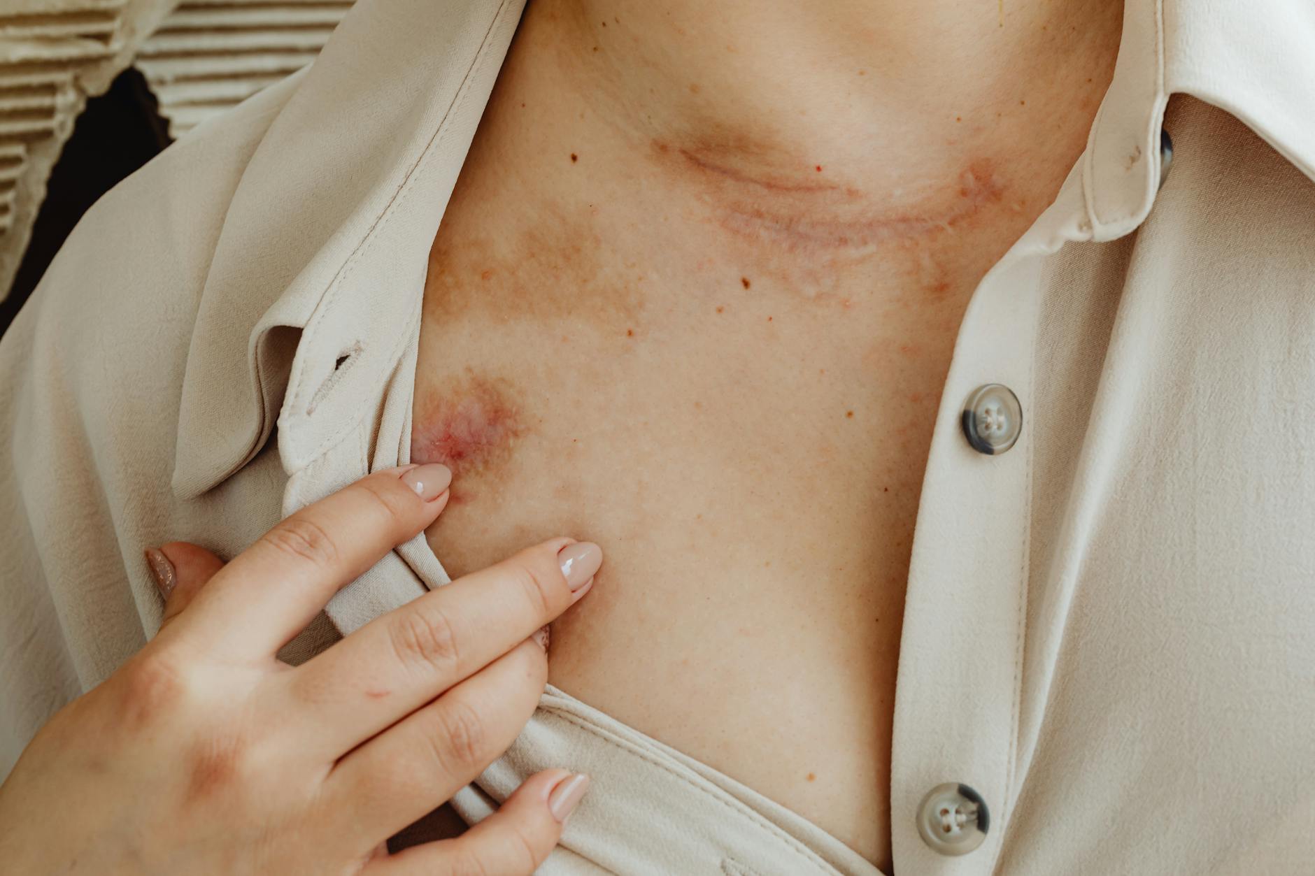 What Medical Tourism for Acne Scar Treatment Involves - Featured image