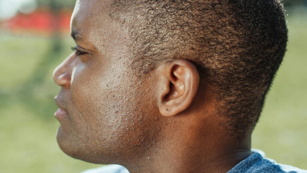 What Multiple TCA Cross Sessions Do for Deep Ice Pick Scars - Featured image