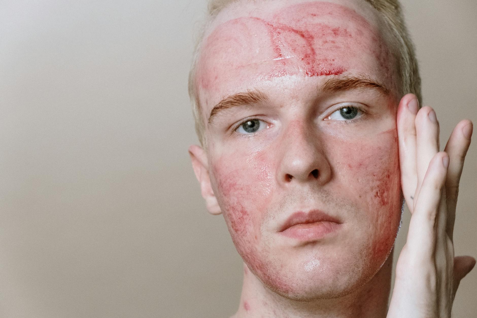 What the American Academy of Dermatology Acne Guidelines Say - Featured image