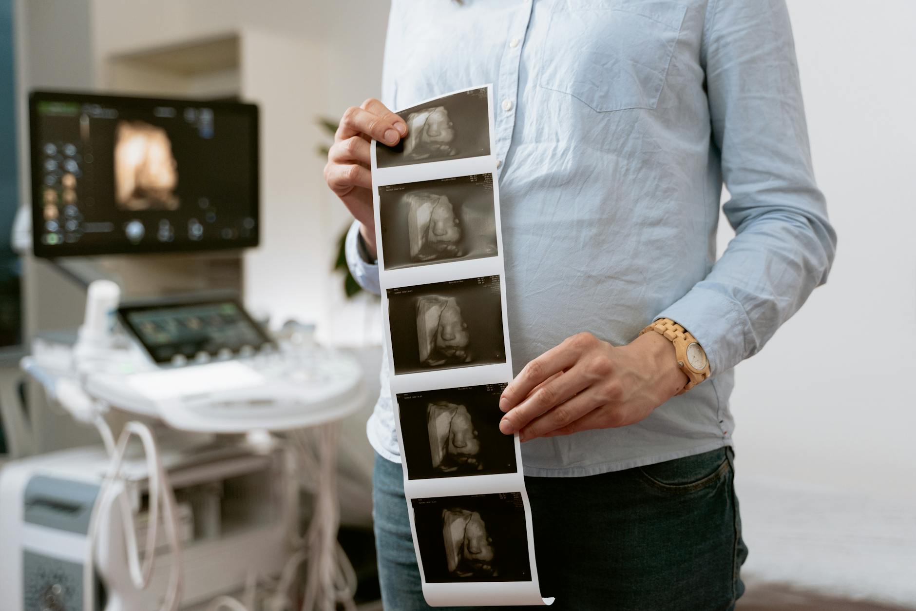 What Ultrasound Imaging of Acne Cysts Shows Dermatologists - Featured image