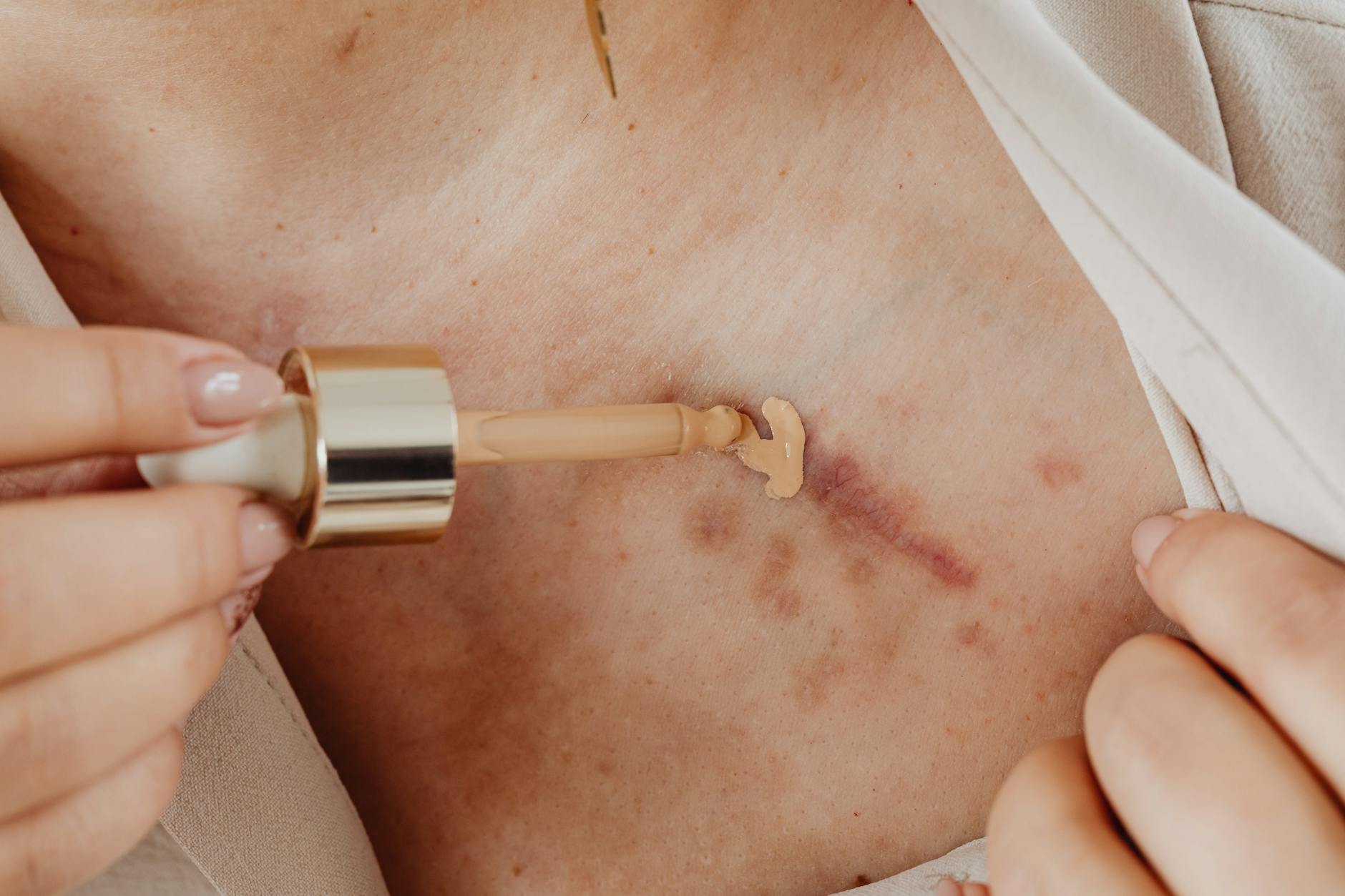 What XoGlo Exosomes Do for Acne Scar Remodeling - Featured image