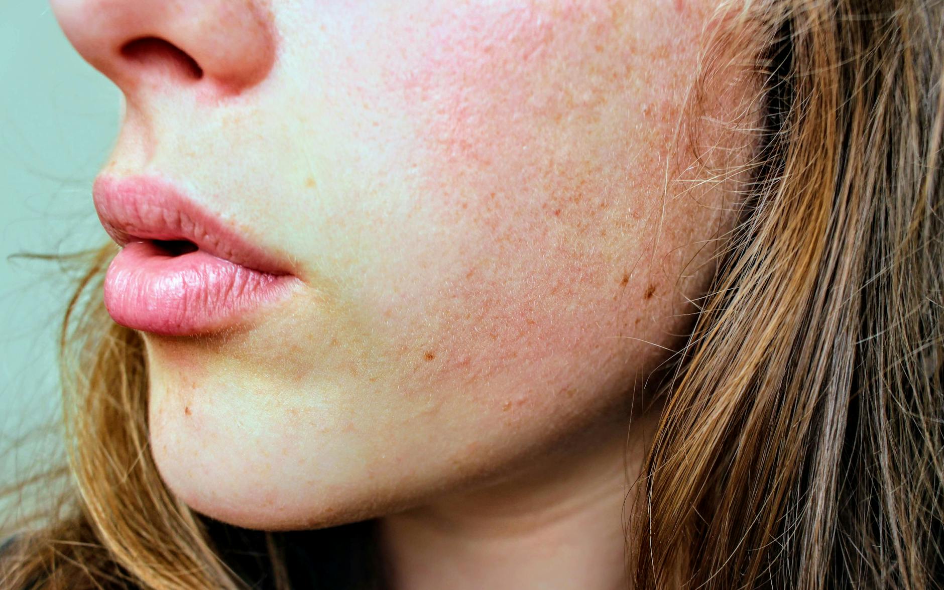 What Zilxi Does for Inflammatory Rosacea That Looks Like Acne - Featured image