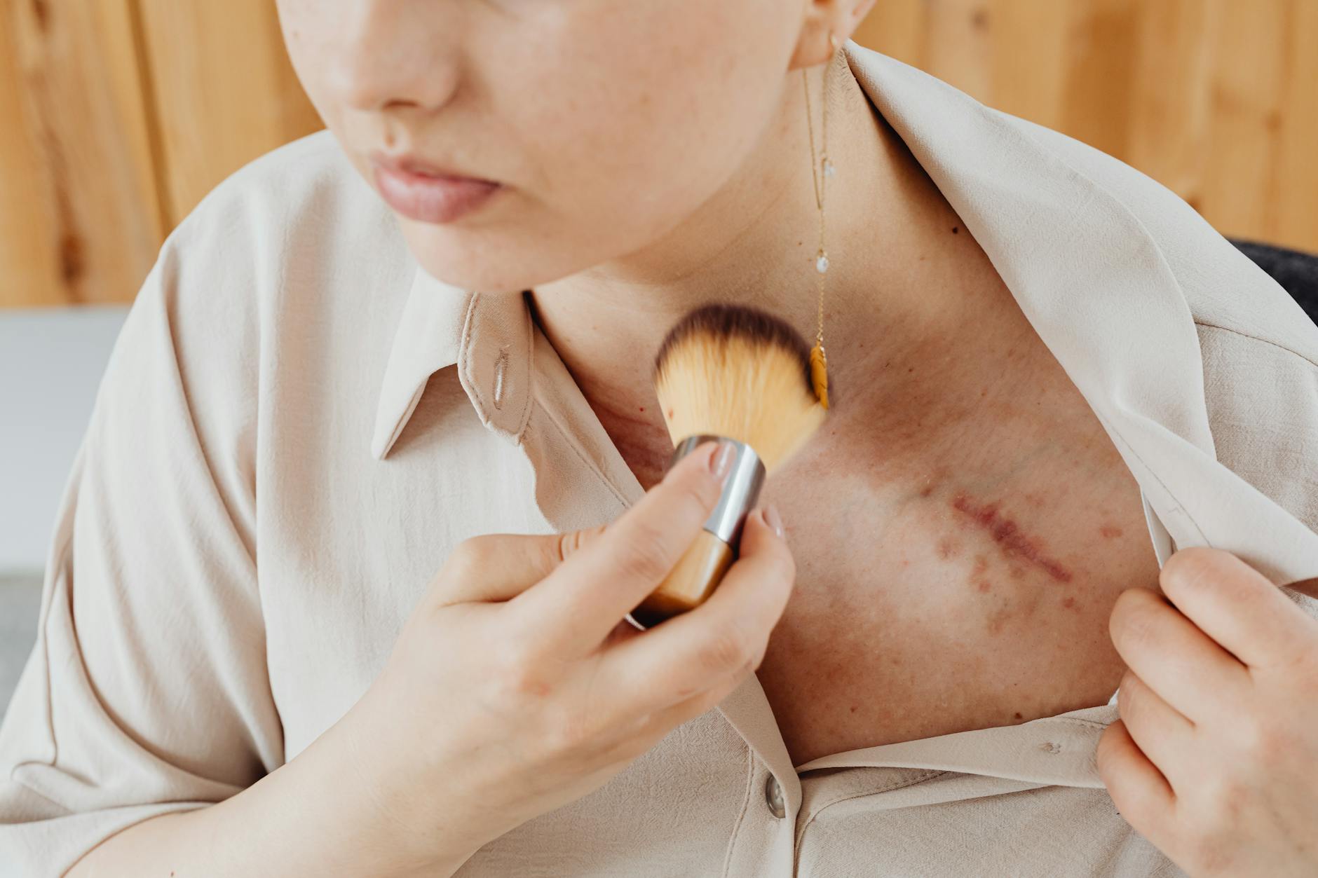Which Acne Scars Are Most Affected by Weight Loss