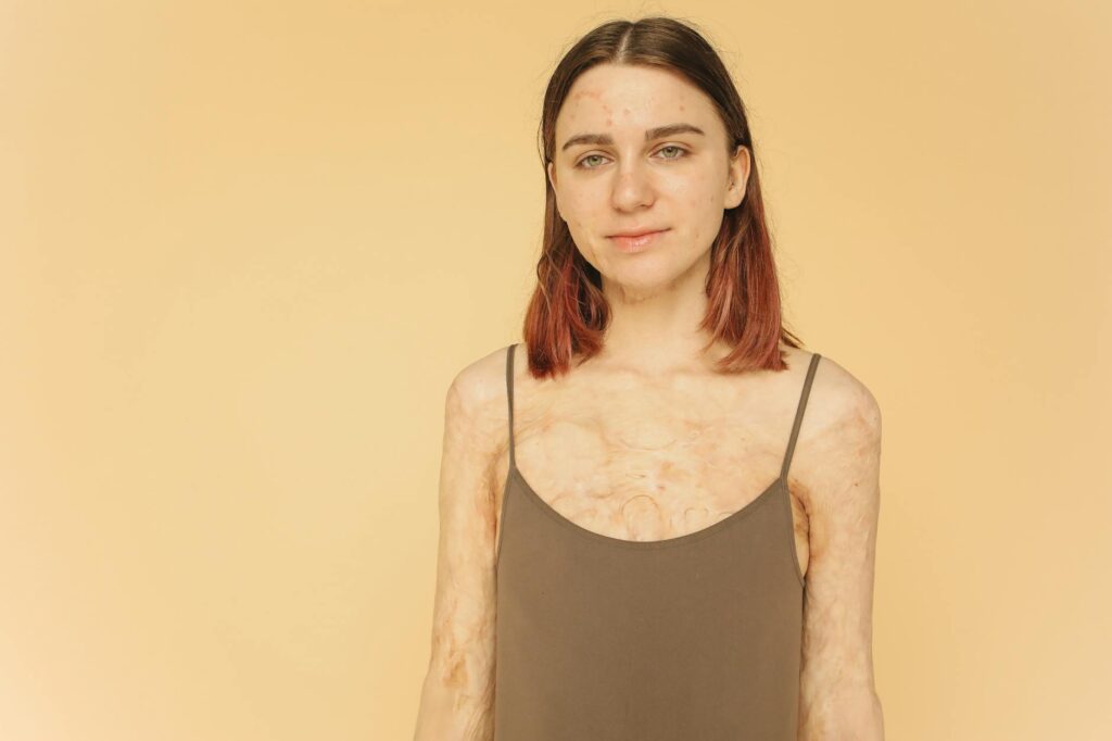 Why Chemical Reconstruction of Skin Scars Works for Pitted Acne - Featured image