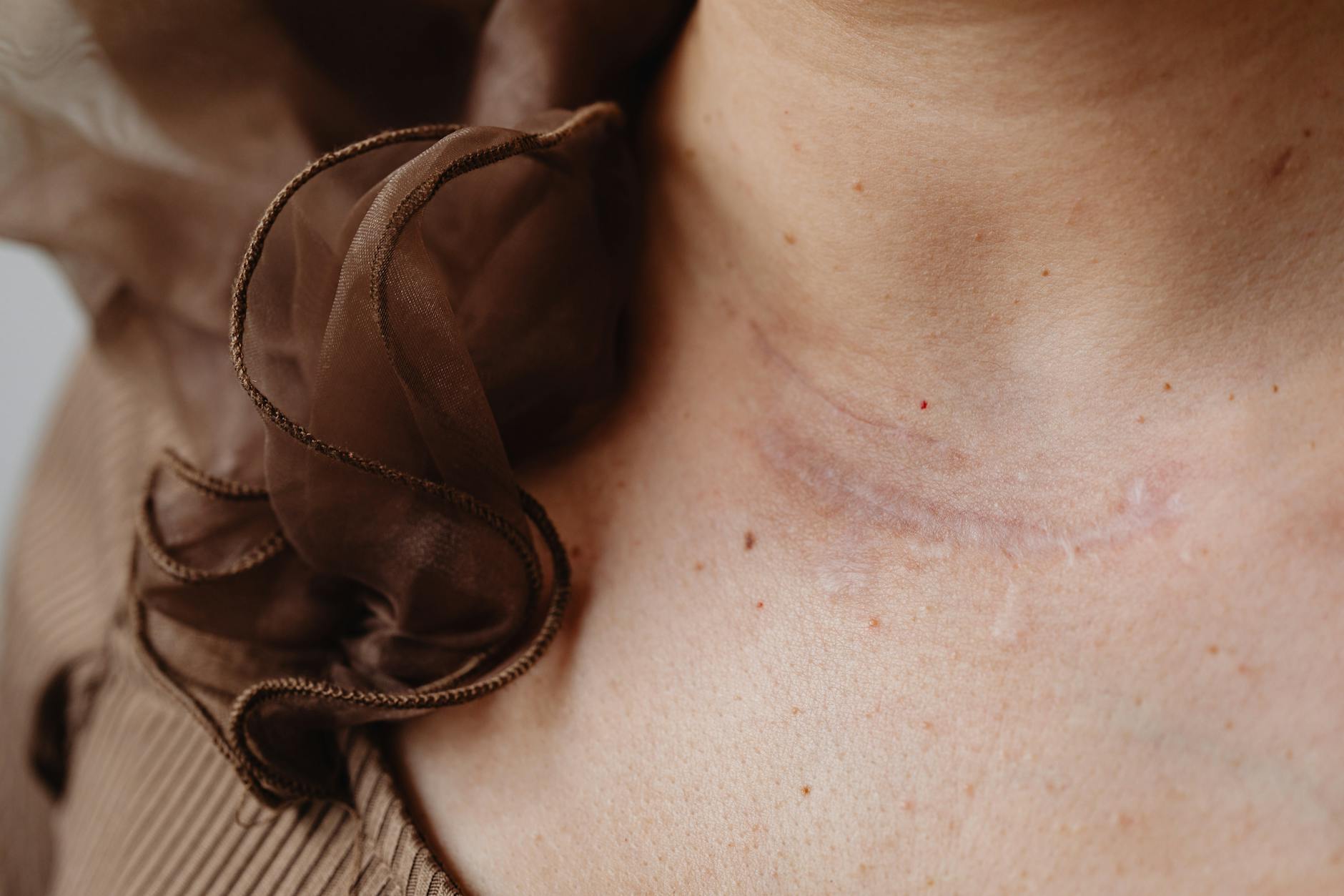Why Complete Acne Scar Removal Is Rarely Possible - Featured image