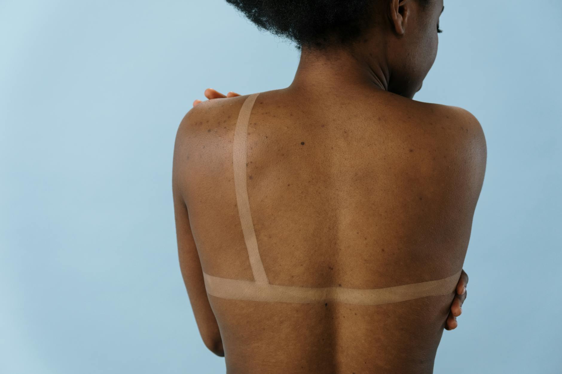 Why Darker Skin Tones Have Higher Laser Complication Risk - Featured image