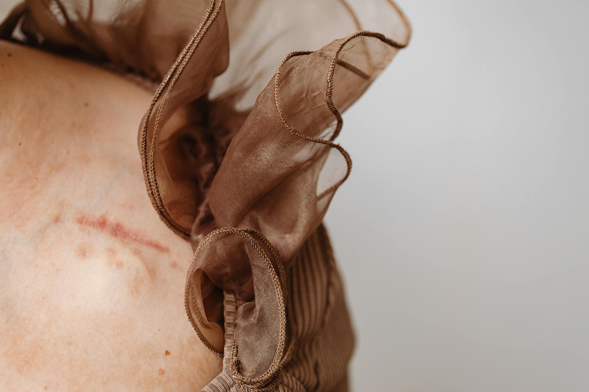 Why Do Younger Scars Respond Better to Silicone Treatment?