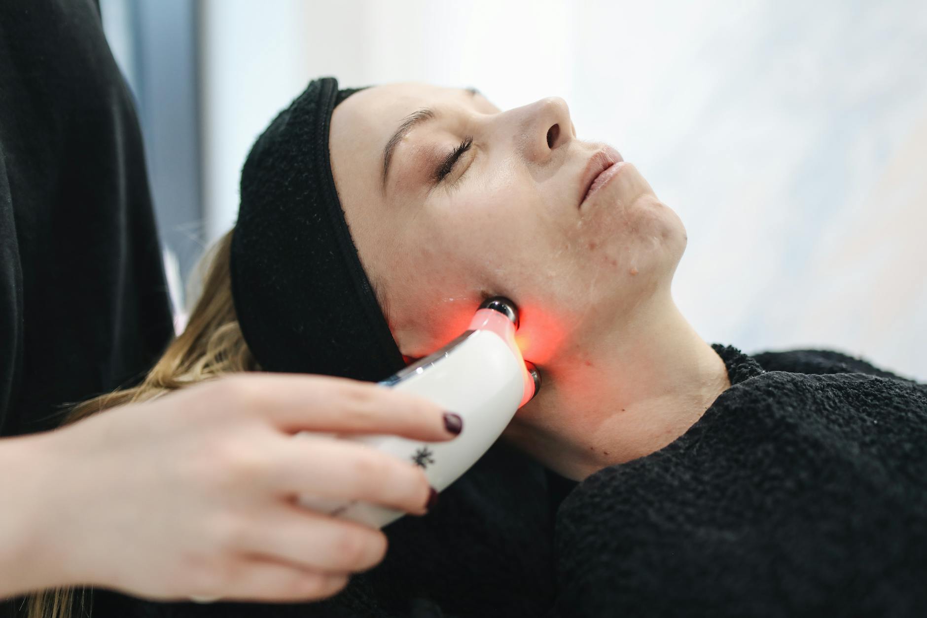 Why Early Scar Treatment After Acne Heals Gives Better Results - Featured image