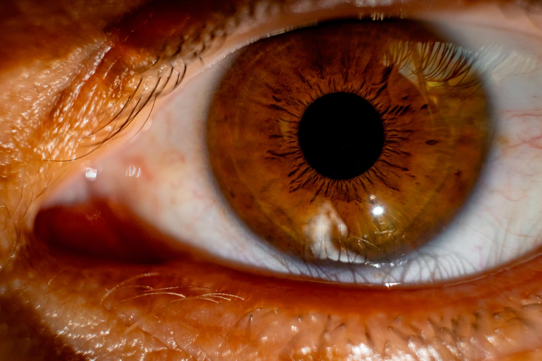 Why Genetics Determine Your Acne Treatment Response