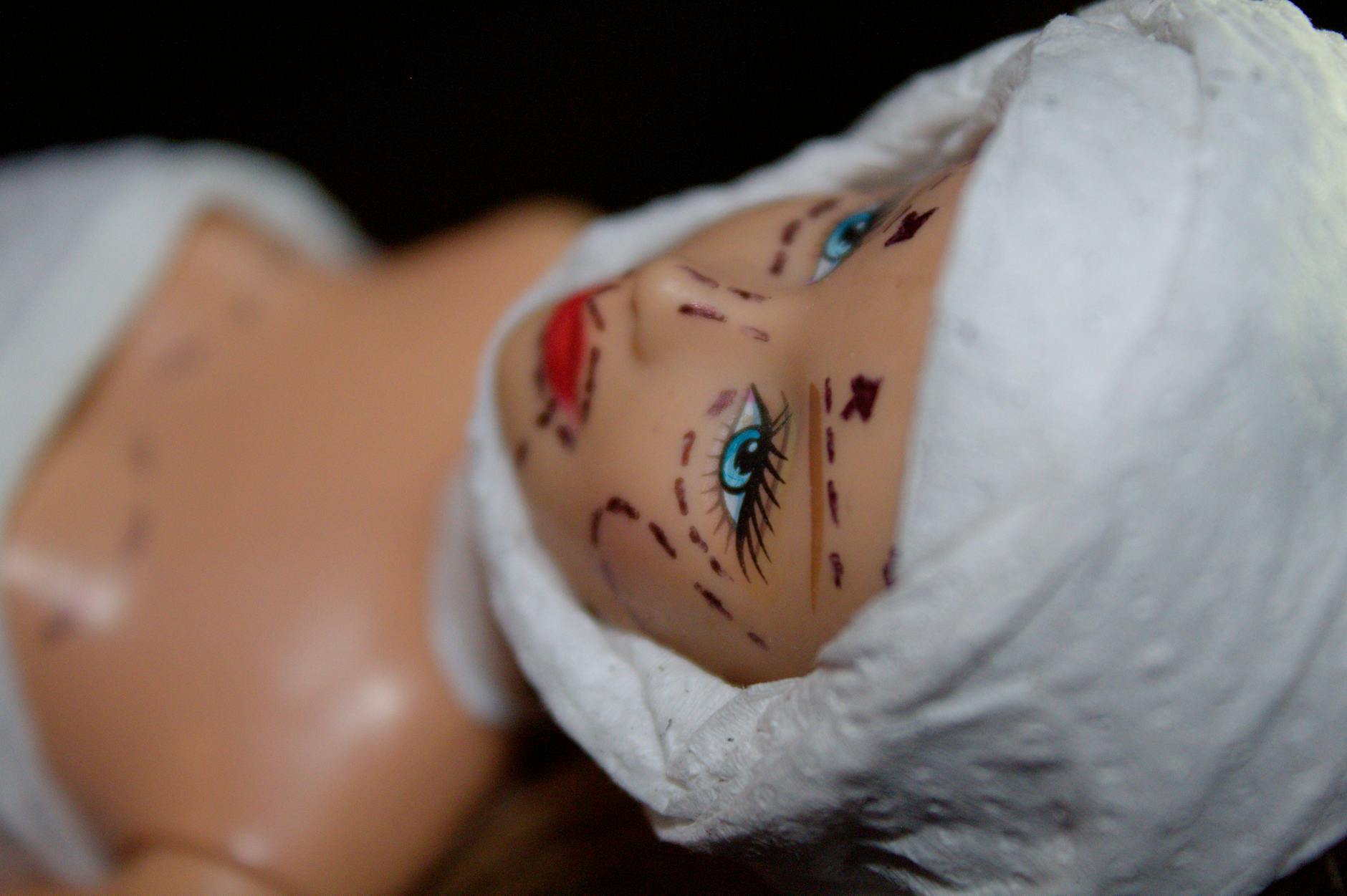 Why Repeat Subcision Works Better on Scar Tissue - Featured image