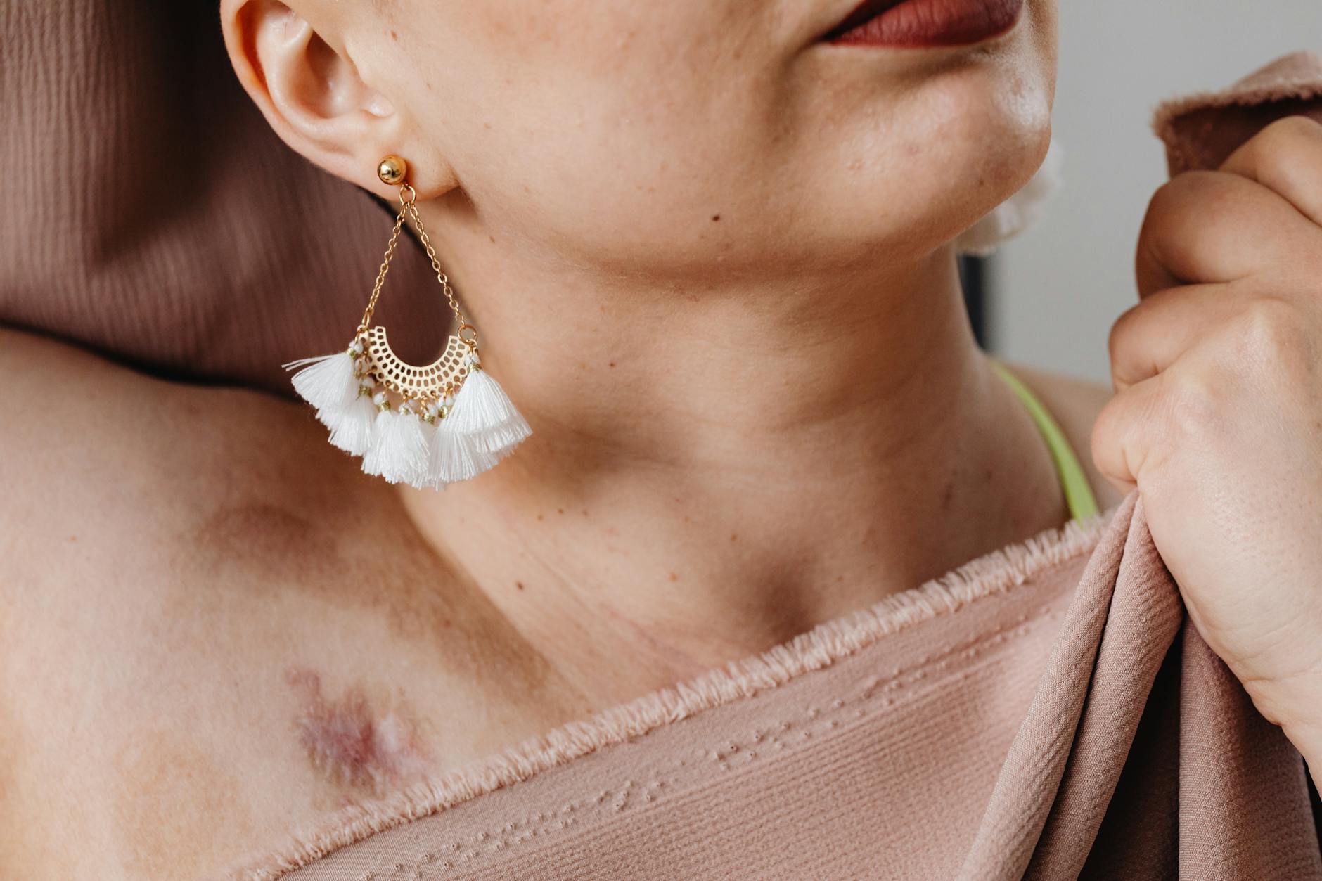 Why Scar Depth and Type Determine Treatment Success