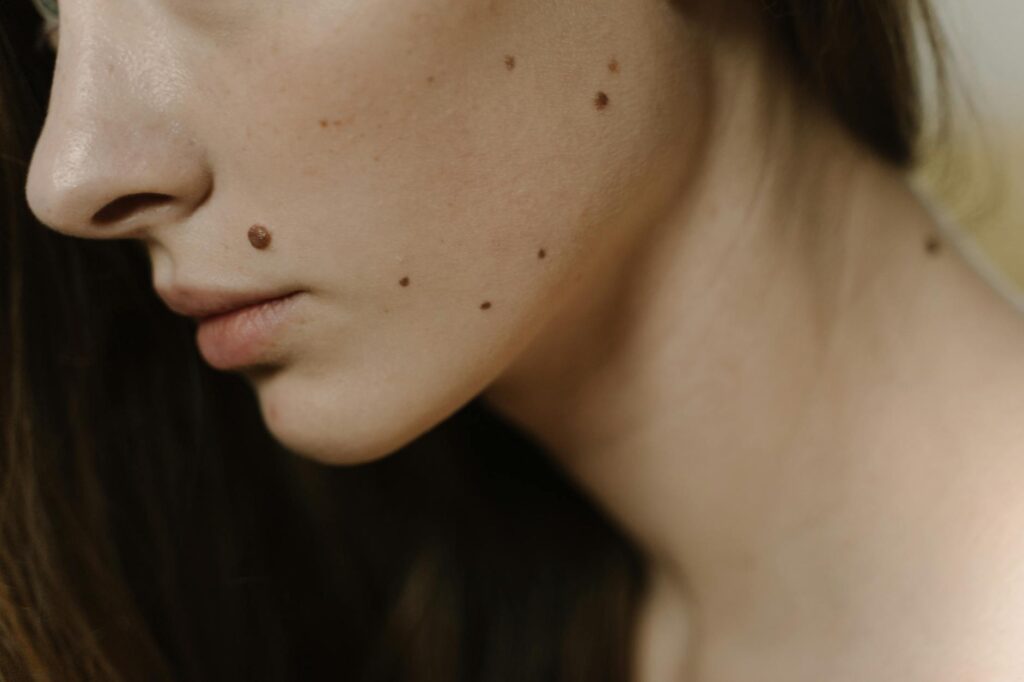 Why Sebaceous Gland Ablation Might Permanently End Acne - Featured image