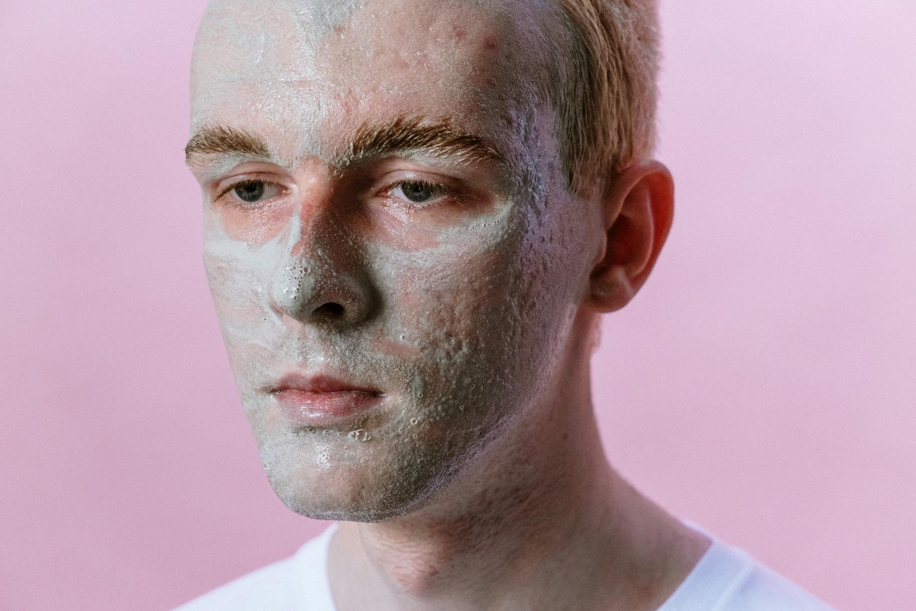 Why Stress Is One of the Most Underrated Acne Triggers - Featured image